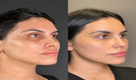 Deep cleansing facial Islamabad