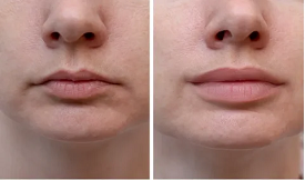 Lip Fillers in Isalamabad