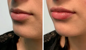 lip filler in Islamabad