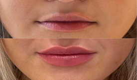 best lip filler in islamabad