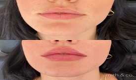 best lip fillers in islamabad