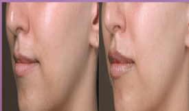 lip fillers in islamabad results