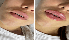 safe lip fillers in islamabad