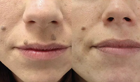 Mole Removal in Islamabad