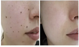 best mole removal in islamabad