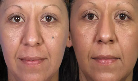 moles removal in islamabad