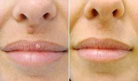 Mole Removal treatment in Islamabad