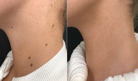 pianless mole removal in islamabad