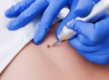 Mole Removal in Islamabad