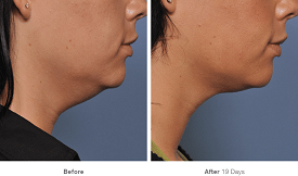 double chin treatments in islamabad