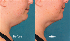 best double chin treatment in islamabad