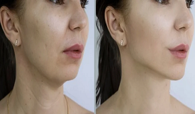 double chin reduction treatment in islamabad 