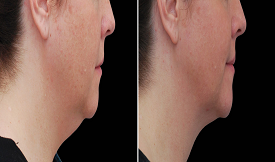 double chin treatment in islamabad clinic