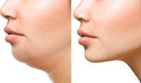 double chin treatment resul;ts in islamabad