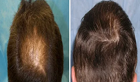 Crown hair transplant in Islamabad