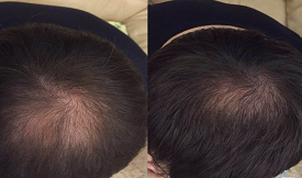 Crown hair transplant result in Islamabad