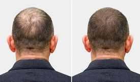 Crown hair transplant results in Islamabad