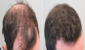 Affordable Crown hair transplant in Islamabad