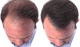 safe Crown hair transplant in Islamabad