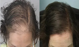 Direct Hair transplant without scar in Islamabad