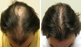 DHI hair transplant results Islamabad