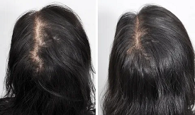 DHI Hair Transplant in islamabad