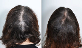 Scarless direct hair transplant Pakistan
