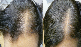 Direct Hair Implant in Islamabad