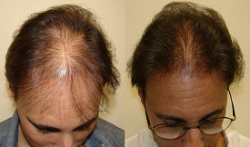 Direct Hair Implant (DHI) in Islamabad
