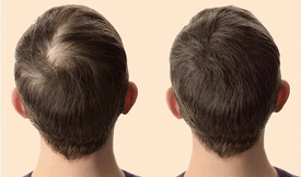 Exosome Hair Therapy in Islamabad