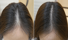 Exosome Hair Therapy results in Islamabad