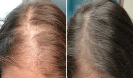 Exosome Hair Therapy result in Islamabad