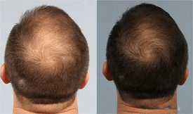 Best Exosome Hair Therapy in Islamabad