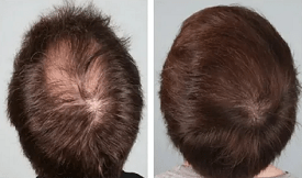 Safe Exosome Hair Therapy in Islamabad