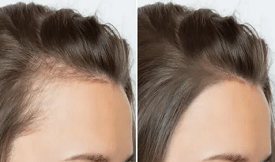Exosome Hair Therapy treatment in Islamabad