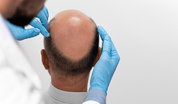 FUE Hair Transplant in Islamabad