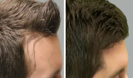 FUT Hair Transplant in Islamabad