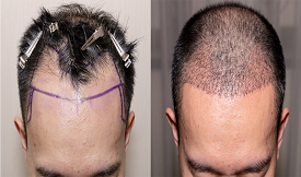 FUT Hair Transplant results in Islamabad