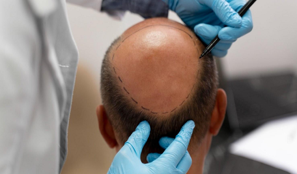 FUT Hair Transplant in Islamabad