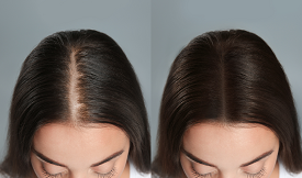 G-Cell Treatment For Hair Loss in Islamabad