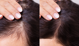 Affordable G-Cell Treatment For Hair Loss in Islamabad