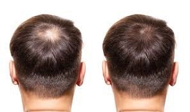 G-Cell Treatment For Hair Loss Result in Islamabad