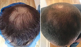G-Cell Treatment For Hair Loss Results in Islamabad