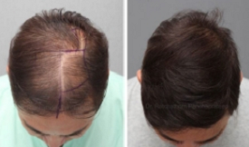 Safe G-Cell Treatment For Hair Loss in Islamabad