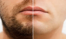 best Moustachee Hair Transplant in Islamabad