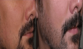 Mustache hair transplant in Islamabad cost