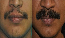 Affordable Moustachee Hair Transplant in Islamabad