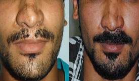 safe Moustachee Hair Transplant in Islamabad