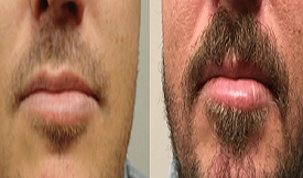 Moustachee Hair Transplant result in Islamabad