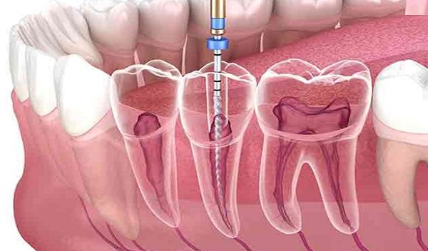 Root Canal Treatment in Islamabad